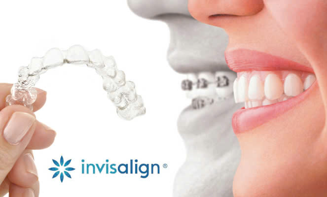 Dịch Vụ Chỉnh Nha INVISALIGN