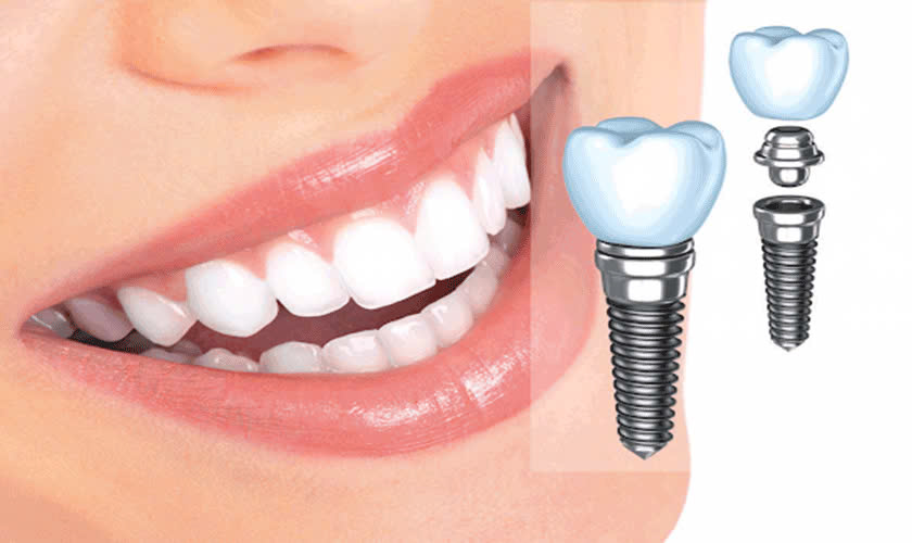 Dịch Vụ IMPLANT