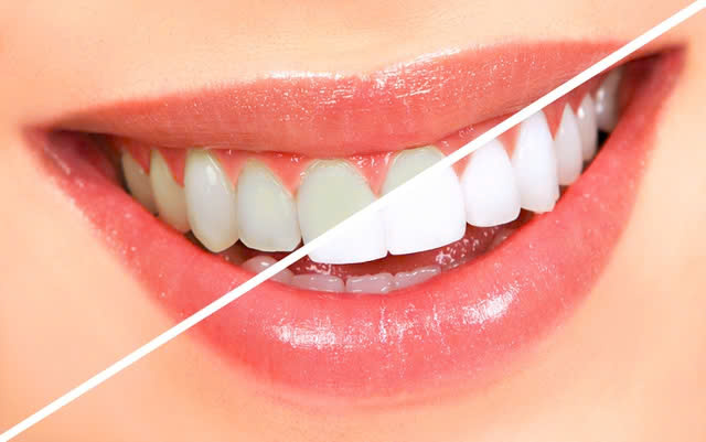 Dịch Vụ Tẩy Trắng Răng