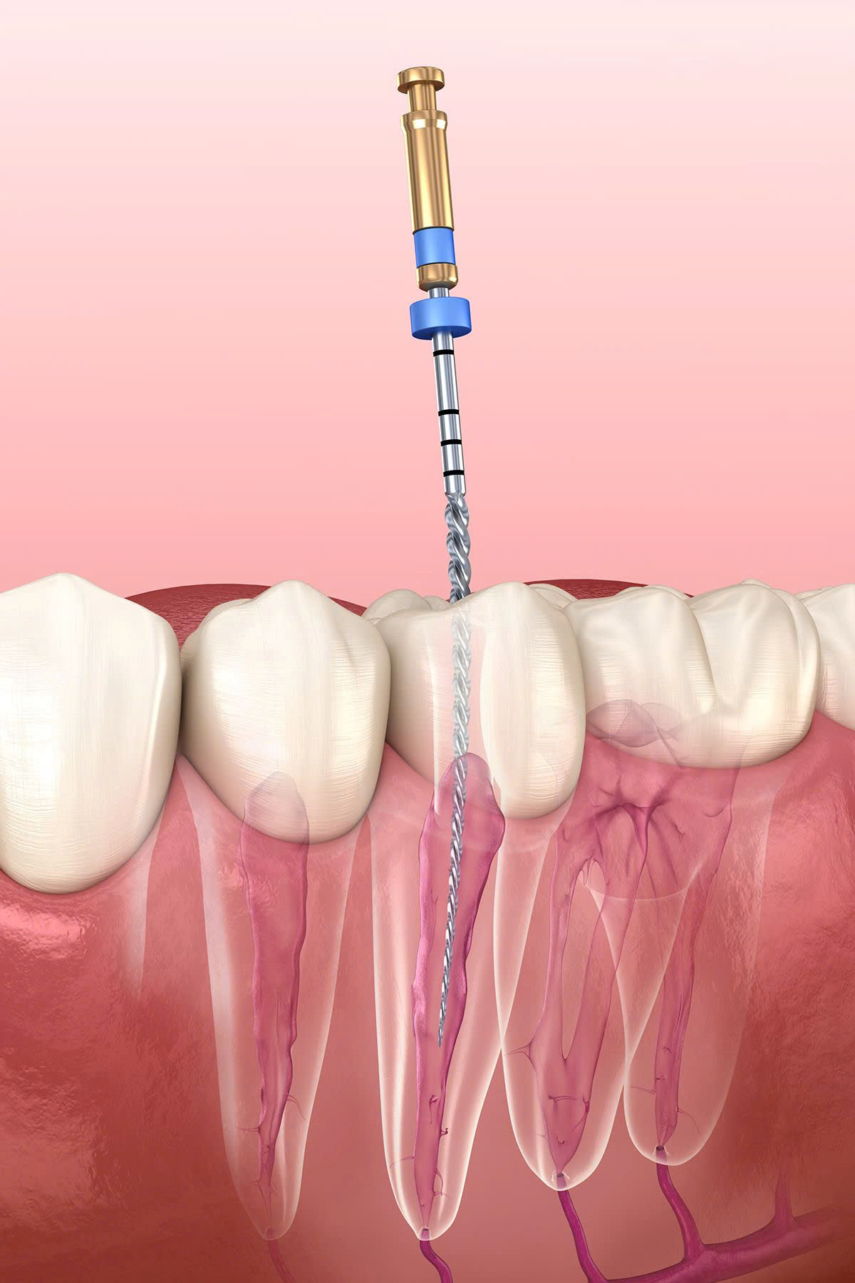 Dịch Vụ Điều Trị Tủy